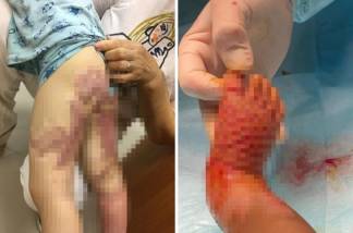 Атырауские врачи шокировали снимками детей с тяжелыми ожогами